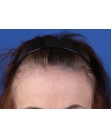 Before Hair Transplant&nbsp;Hairline